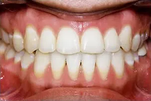 porcelain veneers smile two after